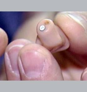 Pierwszy w Polsce niewidoczny implant ucha środkowego