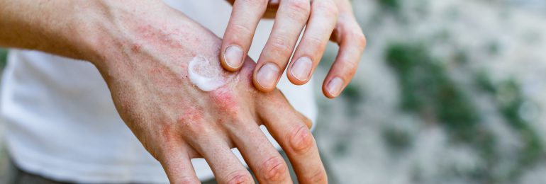 Skuteczne leczenie atopowego zapalenia skóry (AZS) staje się rzeczywistością