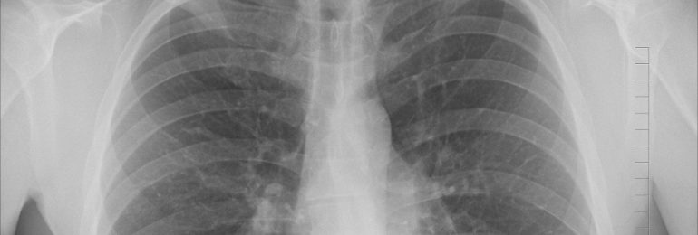 Nowe odkrycie pokazuje, dlaczego COVID-19 uszkadza płuca