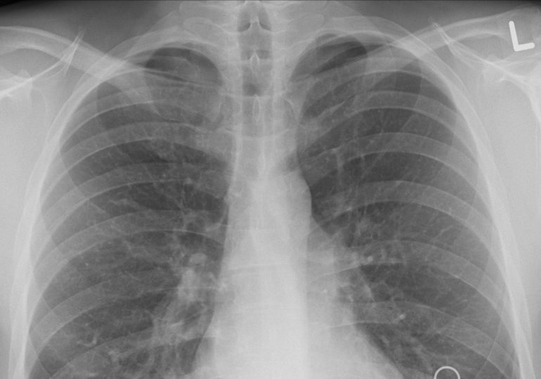 Nowe odkrycie pokazuje, dlaczego COVID-19 uszkadza płuca