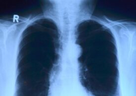 1 sierpnia - Światowy Dzień Raka Płuca. Dobre wiadomości dla pacjentów